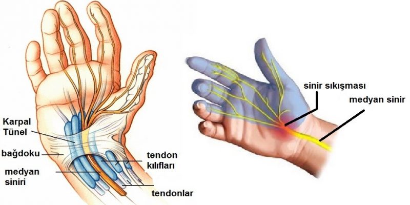 karpal tünel sendromu