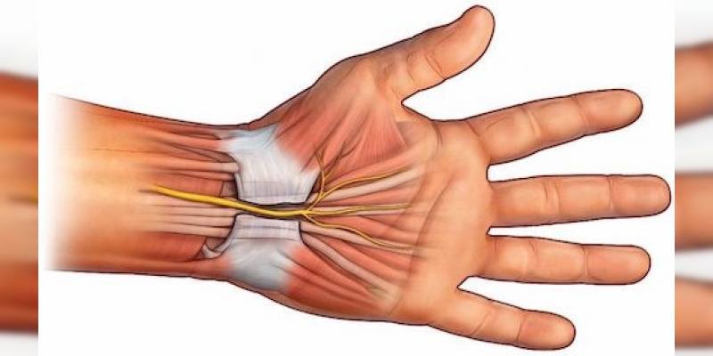 karpal tünel sendromu