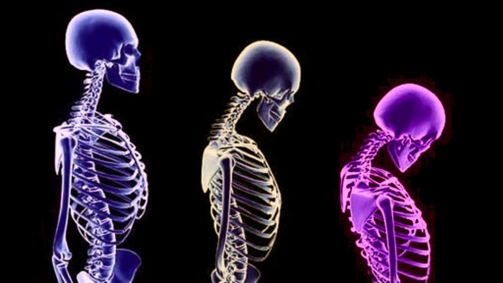 osteoporoz