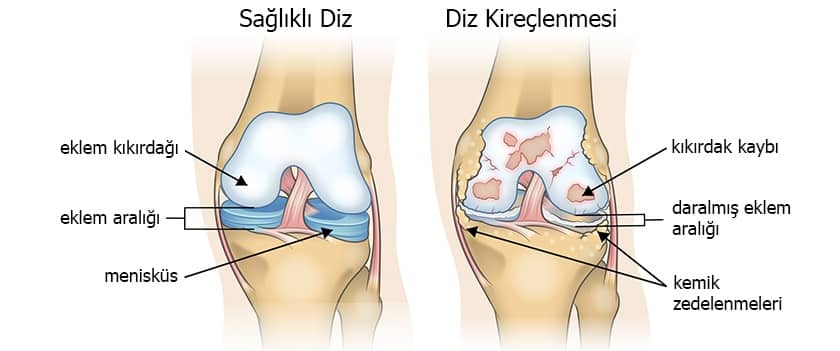 osteoartrit